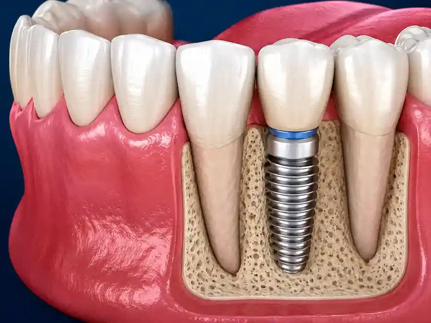 Dental implants in Kishangarh at JP Dental Hospital